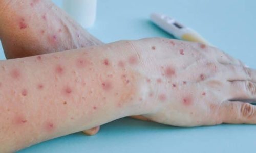 Primeiro caso de varíola é confirmado em São Luís.